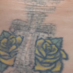 Tattoo Removal of Cross on Back with Laser