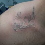 Laser Tattoo Removal Before and After Photo