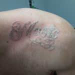 Laser Tattoo Removal Before and After Photo