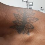 Laser Tattoo Removal Before and After Photo