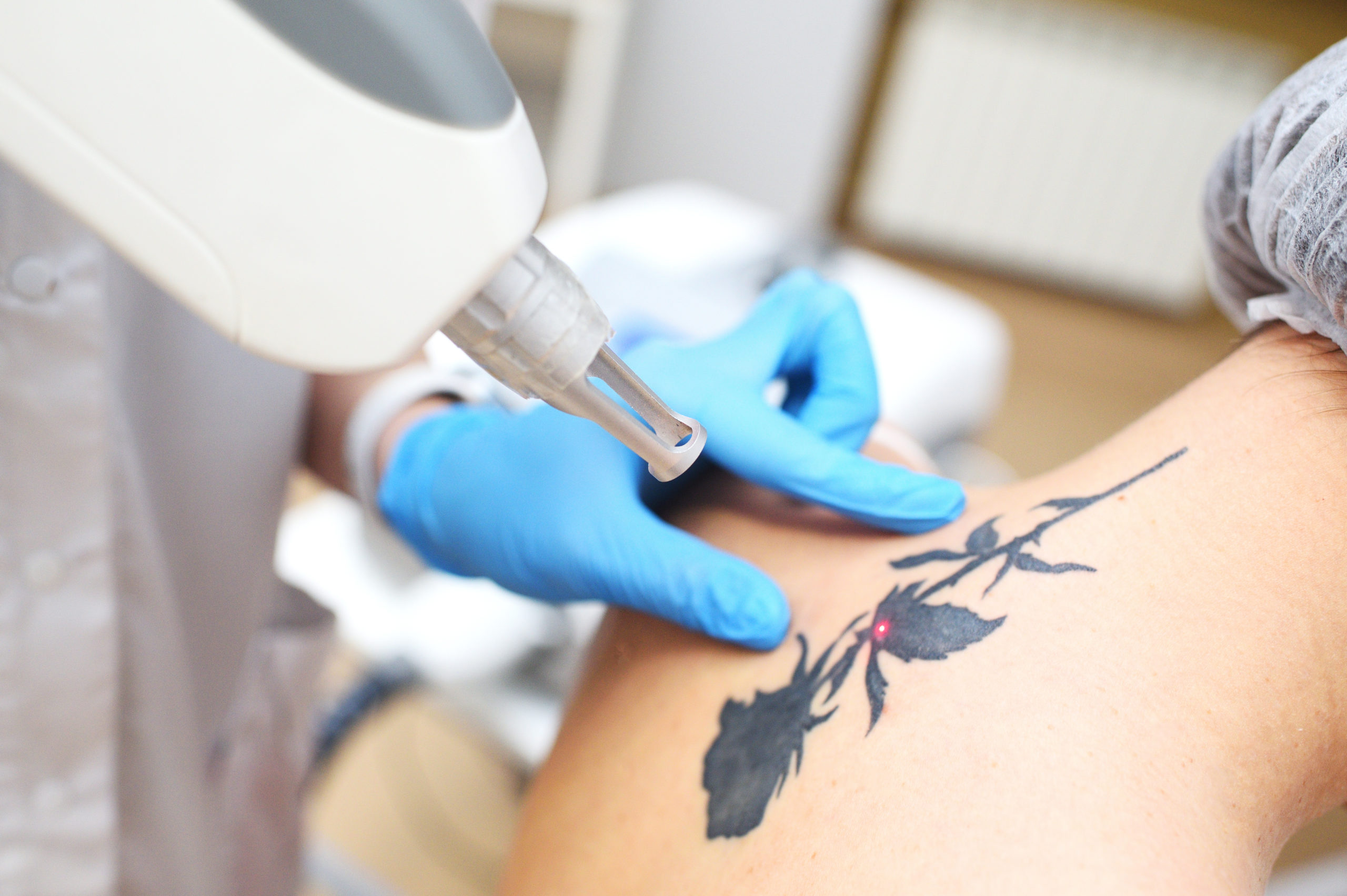 Budget-friendly Tattoo Erasure: Exploring Cost-effective Options At 